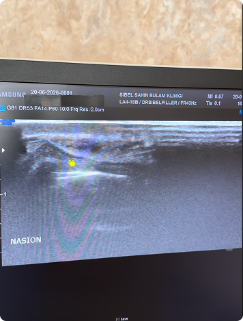 Ultrasonla Burun Dolgusu Eritme Vaka İncelemesi — ultrason görüntüsü