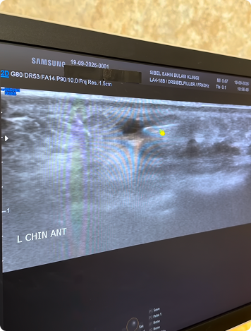 Ultrasonla Çene Dolgusu Eritme Vaka İncelemesi — ultrason görüntüsü
